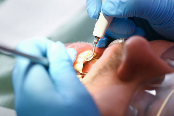 Best Emergency Tooth Extraction in Dacula, GA